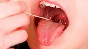 Infecciones por Streptococcus pyogenes. Cuándo consultar y como prevenirlas