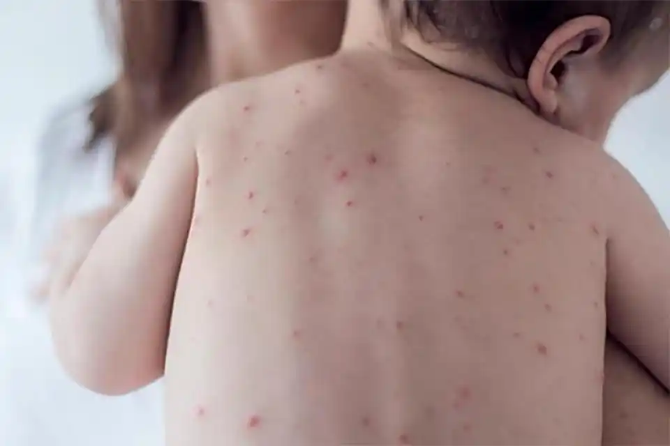 Sarampión en la Provincia: El hogar es el mayor sitio de adquisición del virus