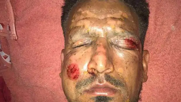 Así quedó Viatri luego de sufrir un accidente con pirotecnia