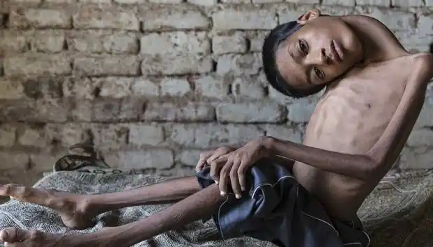 El extraño caso del niño que vive con la cabeza colgando