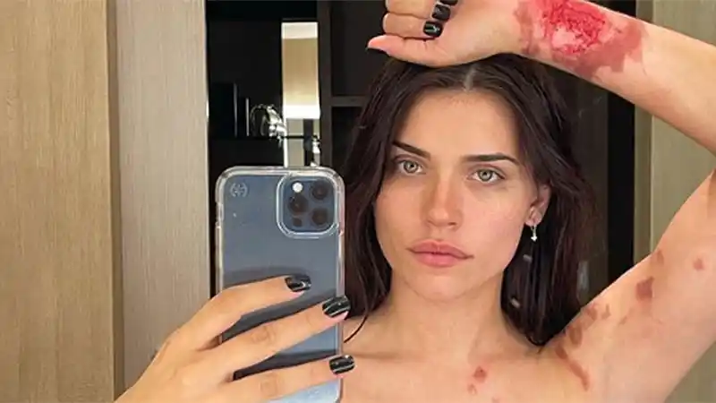 Una famosa actriz publicó impactantes fotos con quemaduras en su cuerpo