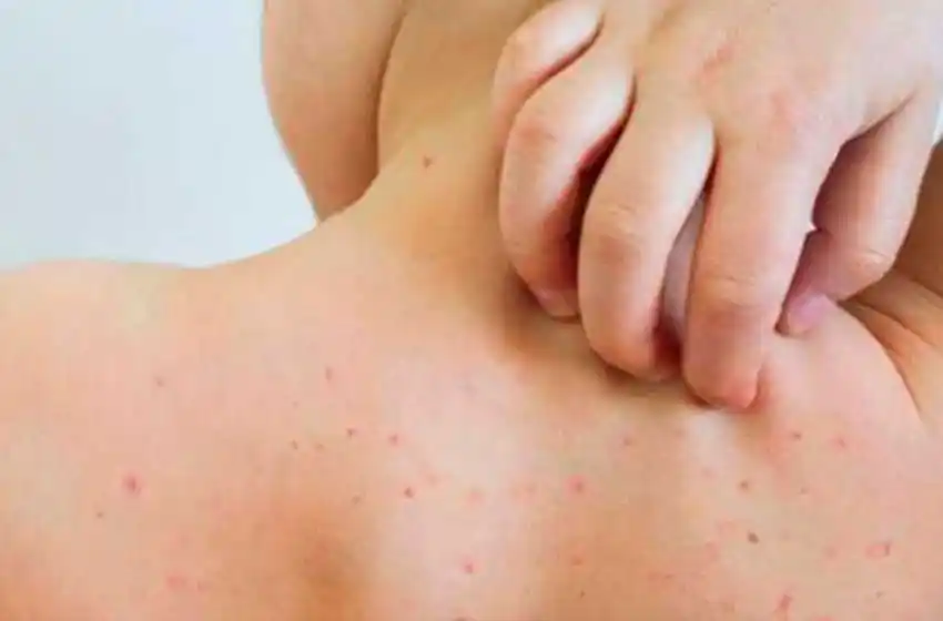 Aumentan los casos de sarampión en la provincia de Buenos Aires