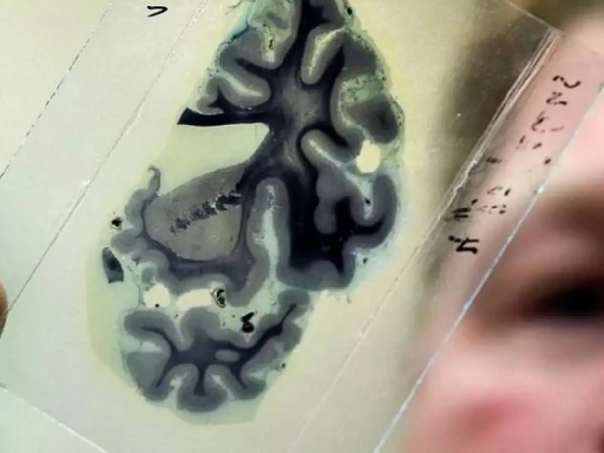 Detectan un caso de Alzheimer en un joven de 19 años