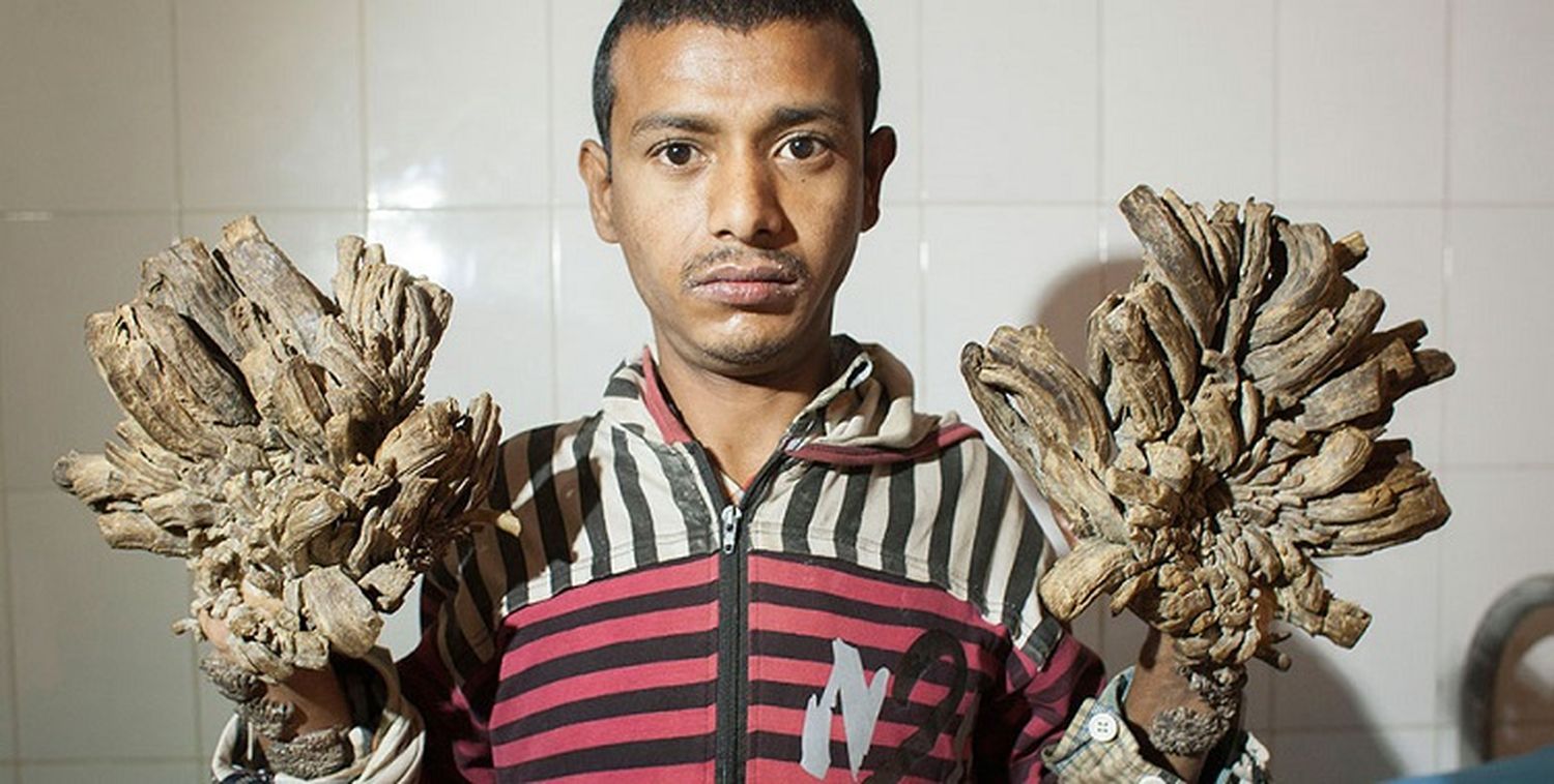 Mirá cómo está hoy el “hombre árbol” de Bangladesh