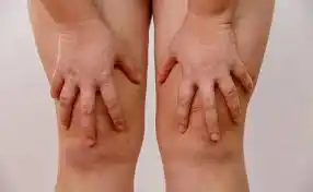 grasa en las piernas