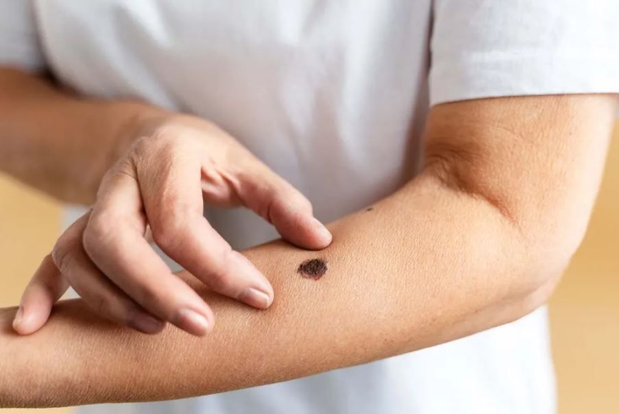 Alarma por el aumento de consultas por cáncer de piel y lesiones premalignas en la ciudad