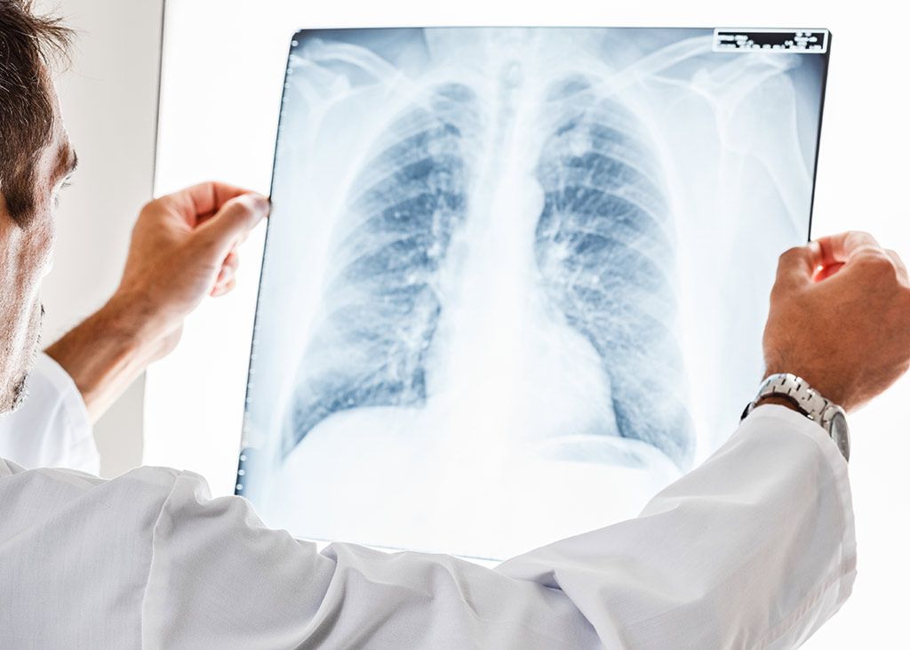 Los nódulos pulmonares se relacionan con el cáncer