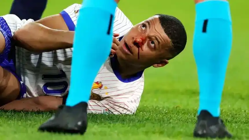 Mbappé se fracturó la nariz, sería operado y puede quedar fuera de la Euro