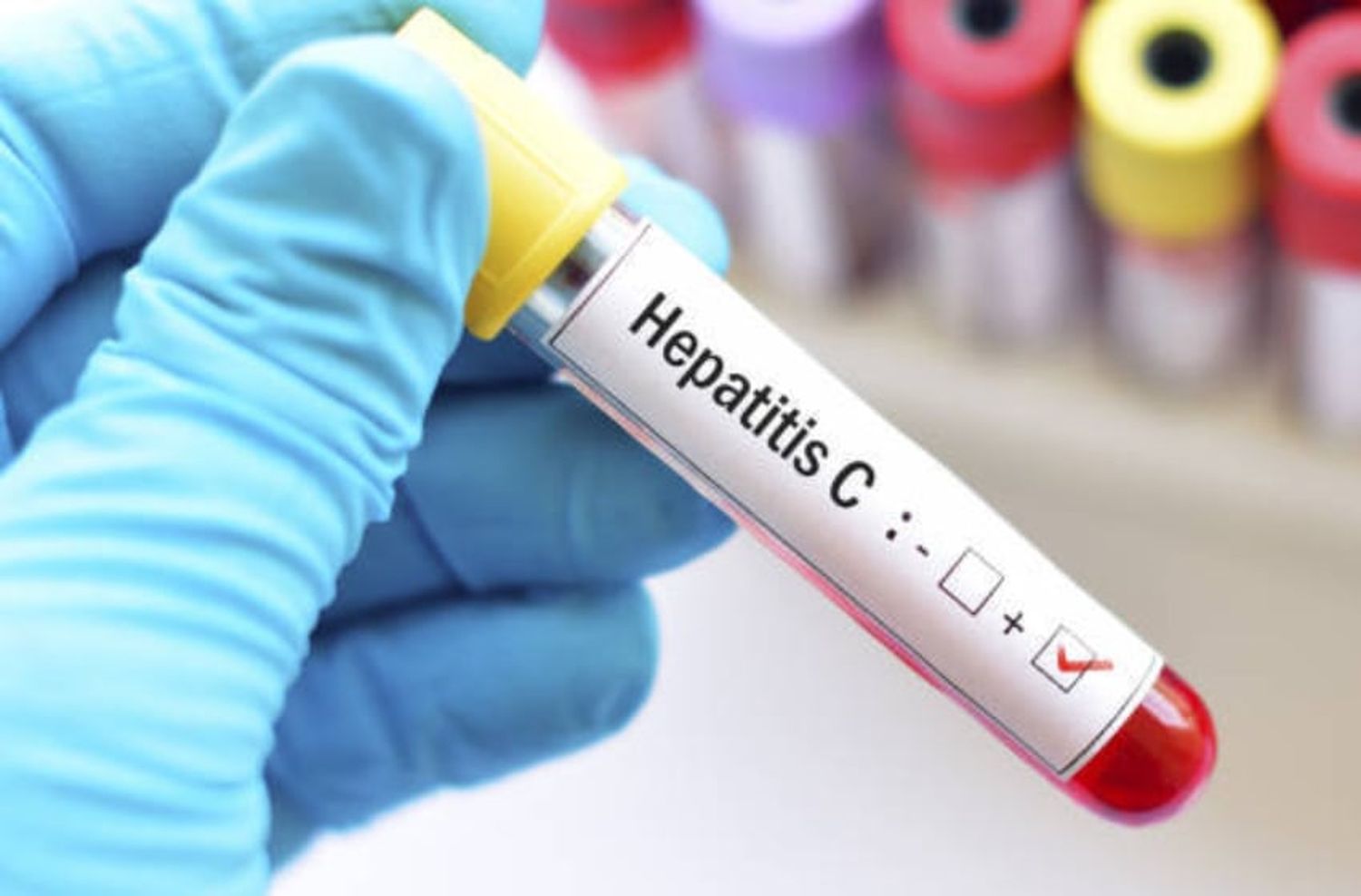 "El 78% de los casos de cáncer hepático primario es por hepatitis B o C"
