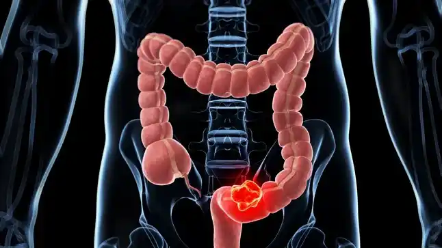 En el país se registran aproximadamente 15.895 nuevos casos por año.