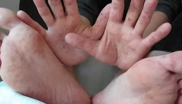 Entre Ríos: detectaron casos de sífilis en niños que sufrieron abuso sexual