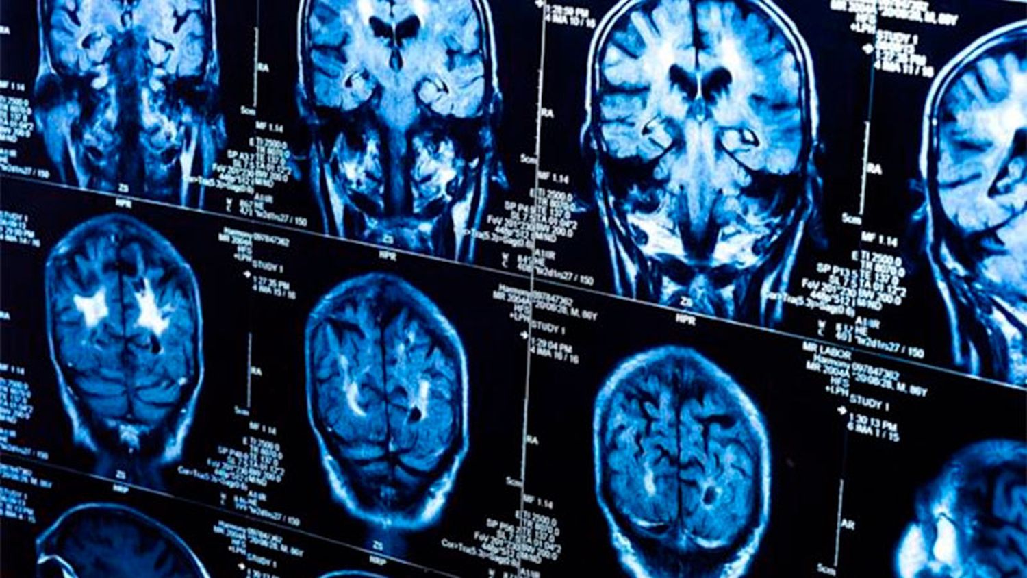 El Covid produce reducción de materia gris en cerebro: las áreas más afectadas