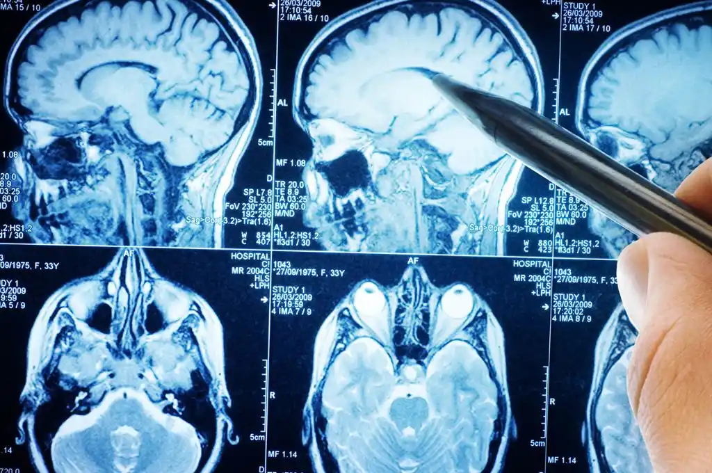 ¿Quién fue el “Paciente M”?: sobrevivió tras recibir un tiro en la cabeza e iluminó el funcionamiento del cerebro