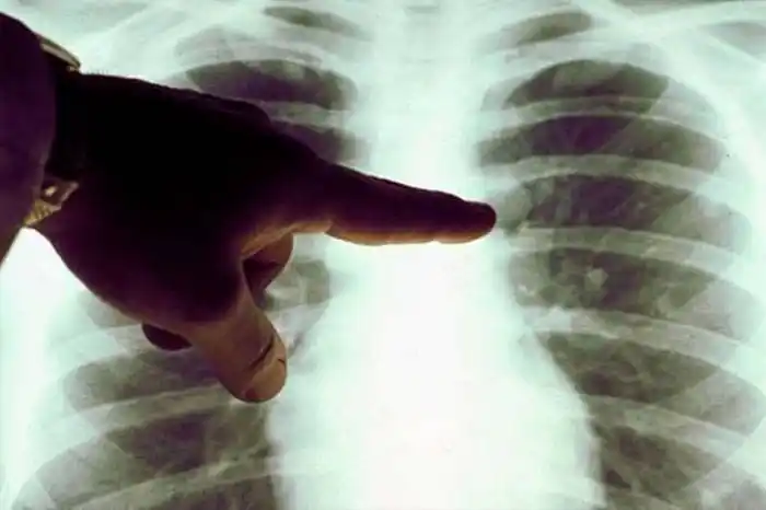 La mortalidad por cáncer en Entre Ríos supera la media nacional