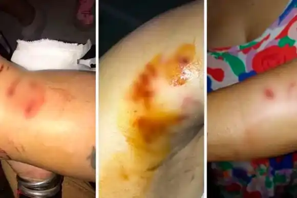 Un pitbull y otro perro atacaron a una mujer en Santa Fe y le "arrancaron un pedazo del pecho"