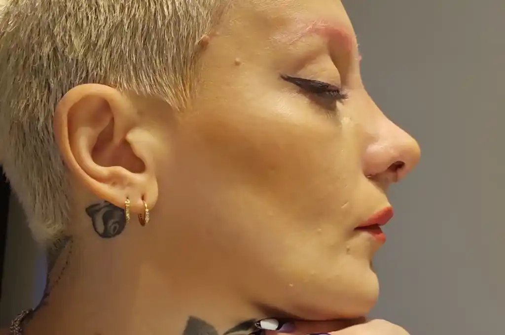 ''Furia'' Scaglione luciendo su nueva nariz