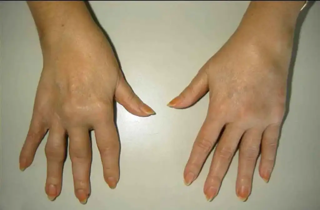 Artritis reumatoidea: por qué controlar el dolor no siempre significa controlar la enfermedad