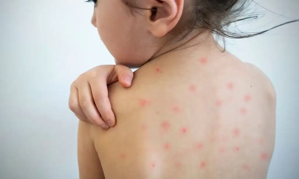 El sarampión afecta a los niños.