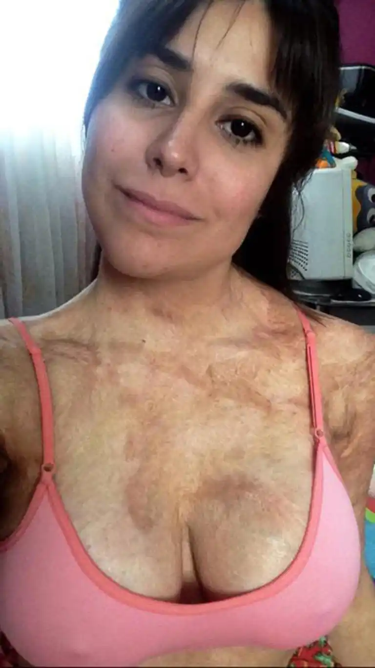 Se prendió fuego mientras hacía el desayuno, sobrevivió y la "sanación" llegó de la forma menos pensada