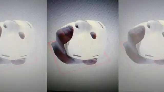 Cirujanos argentinos crearon máscara 3D para reconstrucción facial en casos de quemaduras