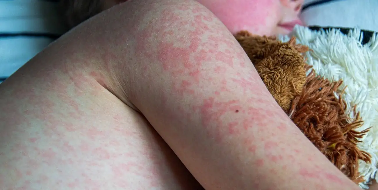 Las alertas epidemiológicas internacionales cumplen un rol clave en la detección temprana