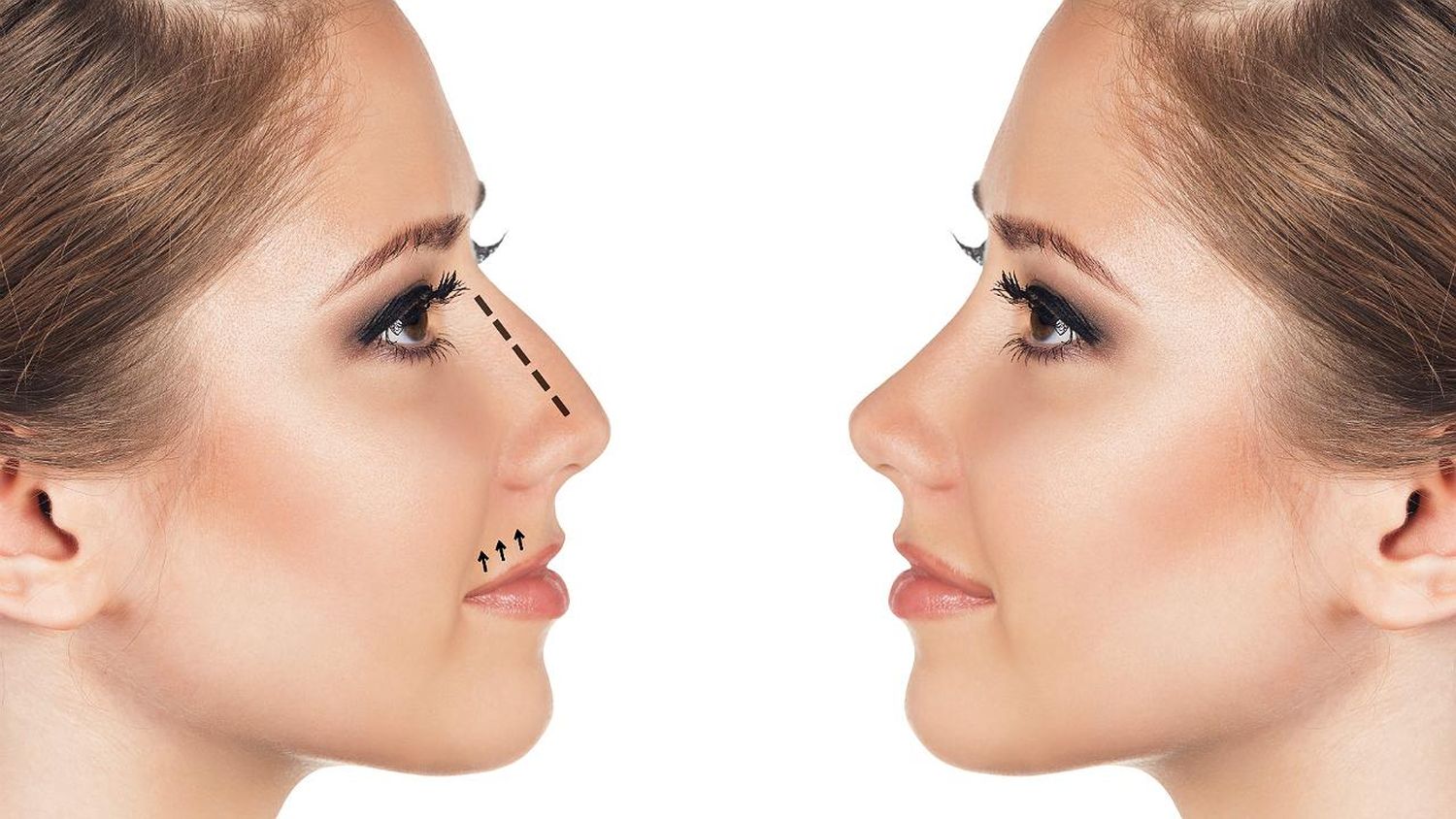 Rinoplastia y Rinomodelación, similitudes y diferencias