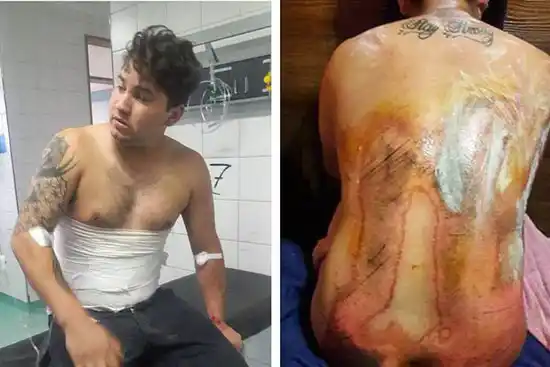 Entre Ríos: Así le quedó la espalda tras una pelea a la salida de un boliche 