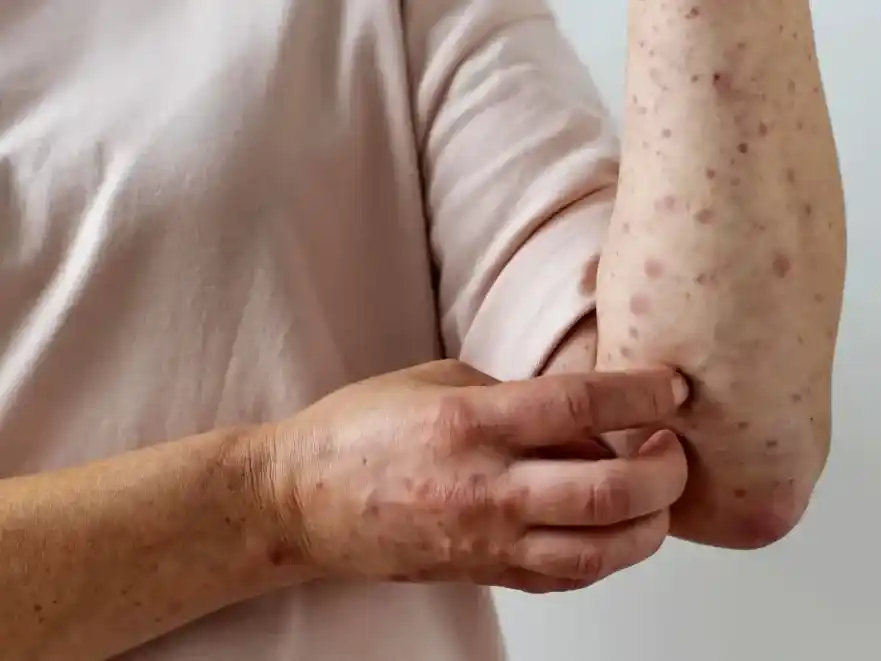 Solicitan a quienes viajaron en ómnibus por Entre Ríos estar atentos ante posible exposición al sarampión