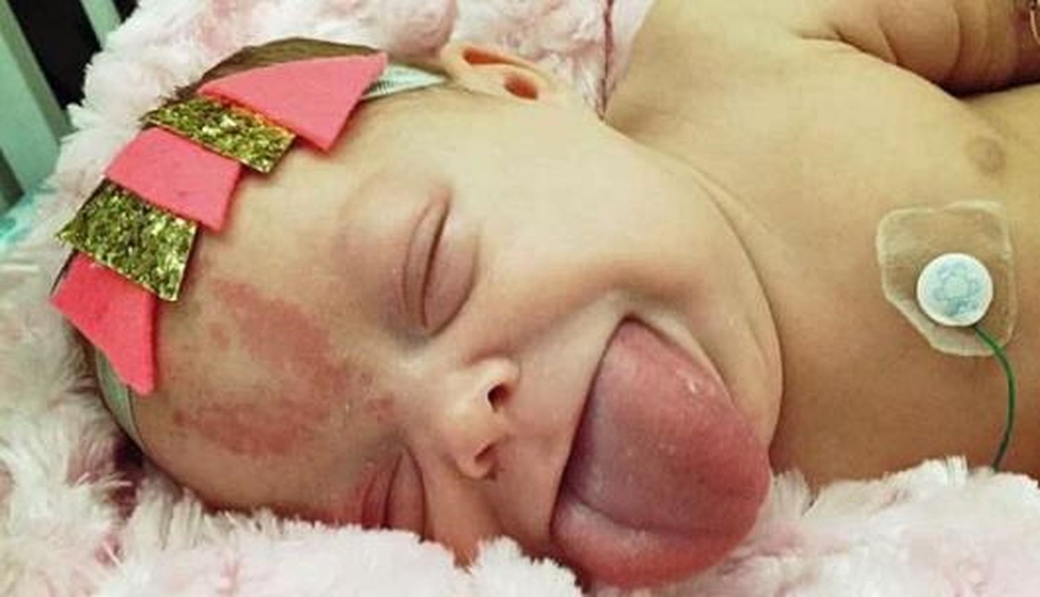 El increíble caso de la bebé que nació con la lengua de un adulto