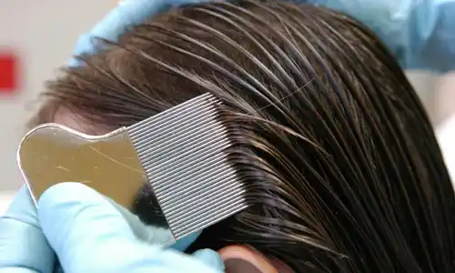 Brindan consejos para prevenir la pediculosis 