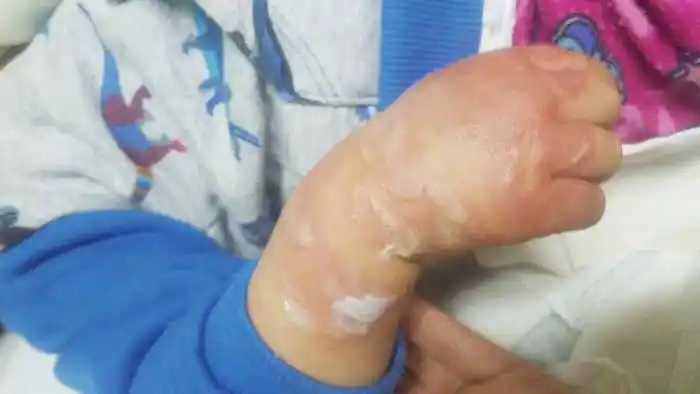 Una madre advierte que en el hospital le provocaron una quemadura en el brazo de su hija