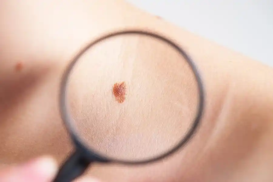Día Mundial del Melanoma: la provincia recuerda la importancia de seguir conductas saludables