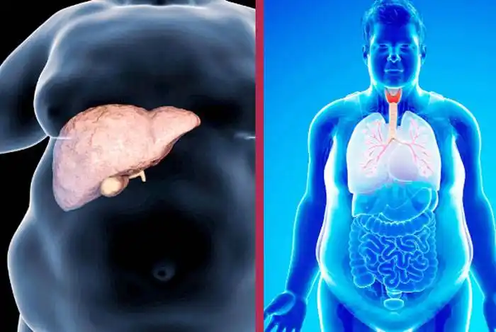 Obesidad y riesgo metabólico: cuáles son  los indicadores que debemos considerar