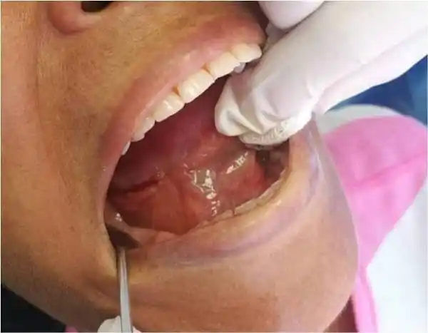 Por el Día Nacional de la Lucha contra el Cáncer Bucal, habrá jornadas gratuitas de control