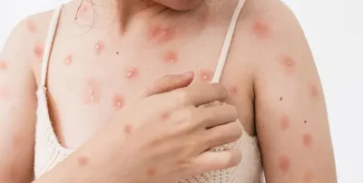 Viruela del Mono: qué es, cuáles son los síntomas y cómo se contagia