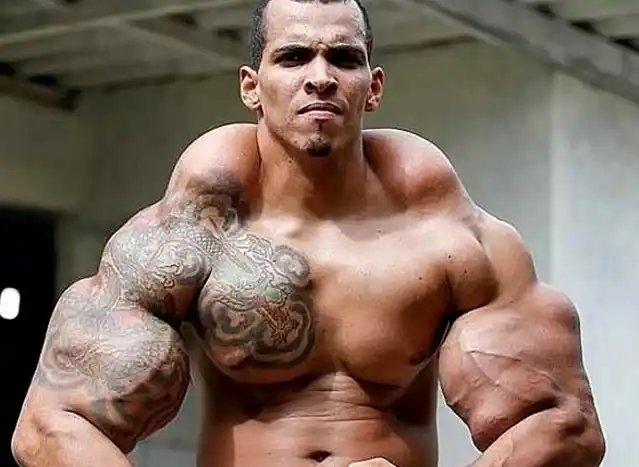 Mirá como quedó "Hulk" tras "desinflarse" para evitar la amputación de sus brazos