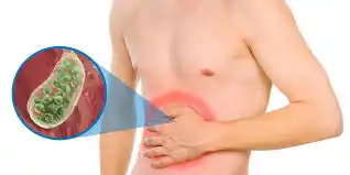 ....Tengo cálculo en la vesícula -Por Dr. Bernardo Gandini