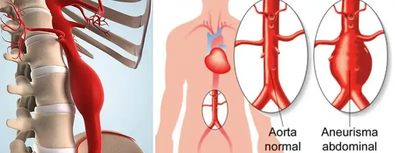Lanzan la campaña gratuita de detección de Aneurisma de Aorta Abdominal