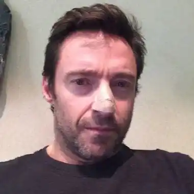 Hugh Jackman se operó de cáncer de piel