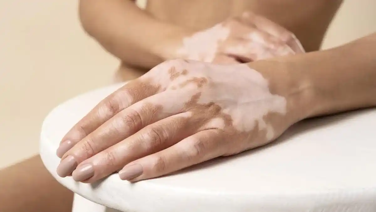 El vitiligo lo padecen millones de personas en el mundo.