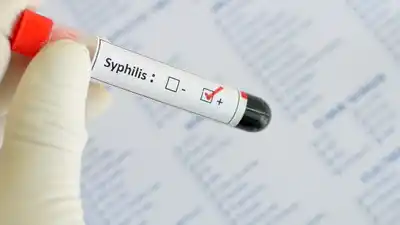Récord de sífilis en Argentina: Córdoba encabeza el ranking de crecimiento