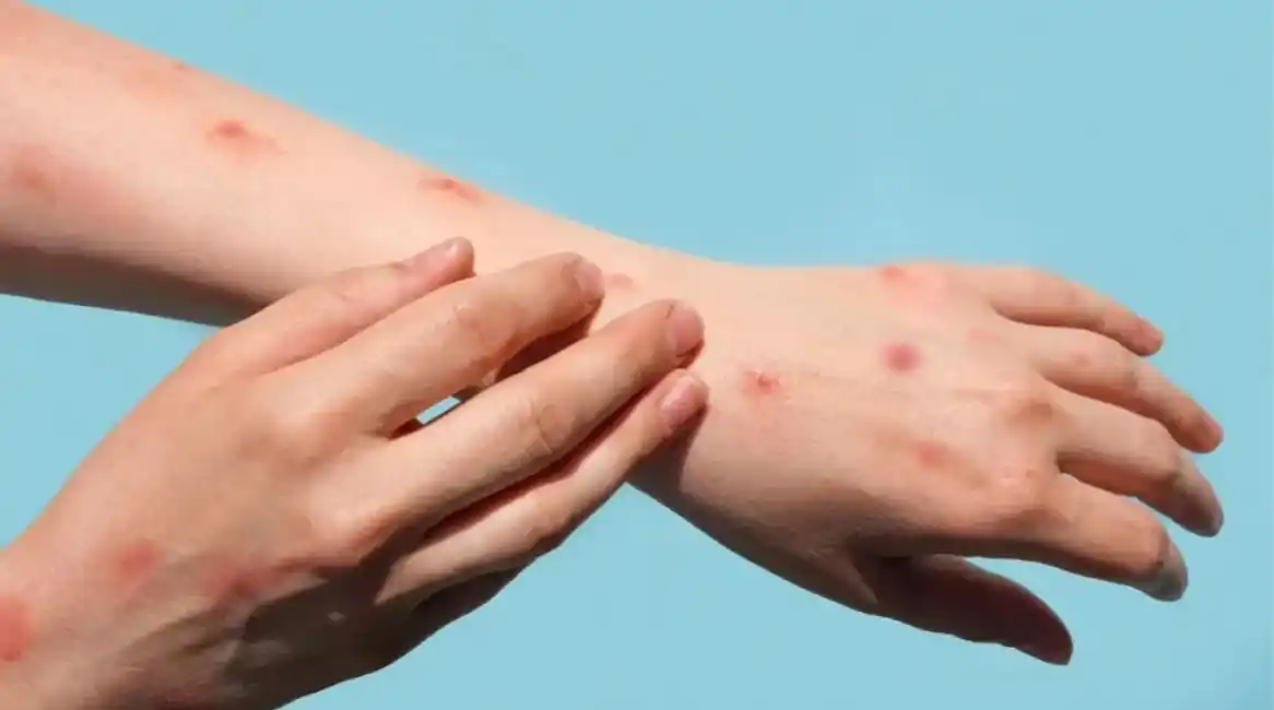 El Ministerio de Salud confirmó el segundo caso de viruela del mono en Rosario