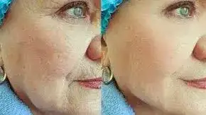 El lifting facial evolucionó desde los procedimientos bidimensionales hacia una técnica tridimensional que prioriza el reposicionamiento de tejidos y la recuperación de volumen.