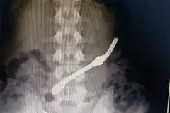 Interno de Unidad Penal de Gualeguay se tragó una bombilla en protesta por un problema familiar