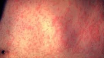 Paraguay confirmó un caso importado de sarampión tras 10 años de eliminación del virus