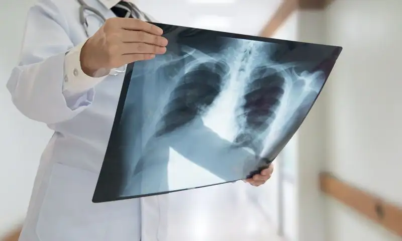 Tuberculosis: advierten sobre el aumento de casos en Gualeguaychú al igual que en el resto del país