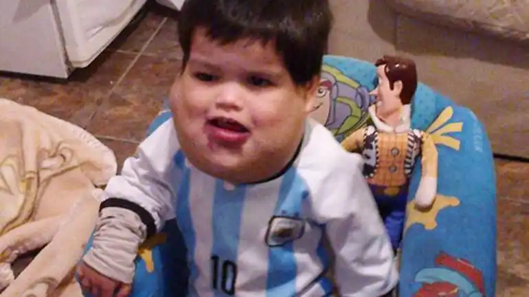 Piden ayuda para Benicio, un chico que sufre linfangioma