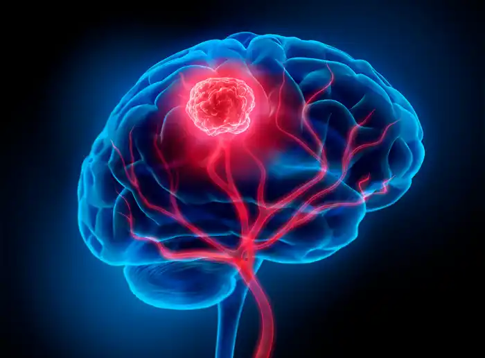 Qué hacen los tumores cerebrales a las neuronas