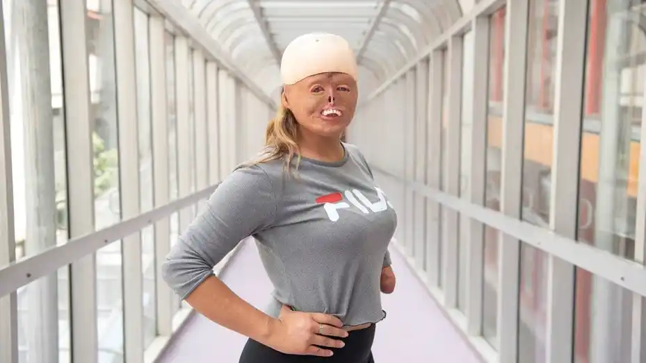Cuando era bebé se quemó el 90% de su cuerpo y hoy es deportista y modelo