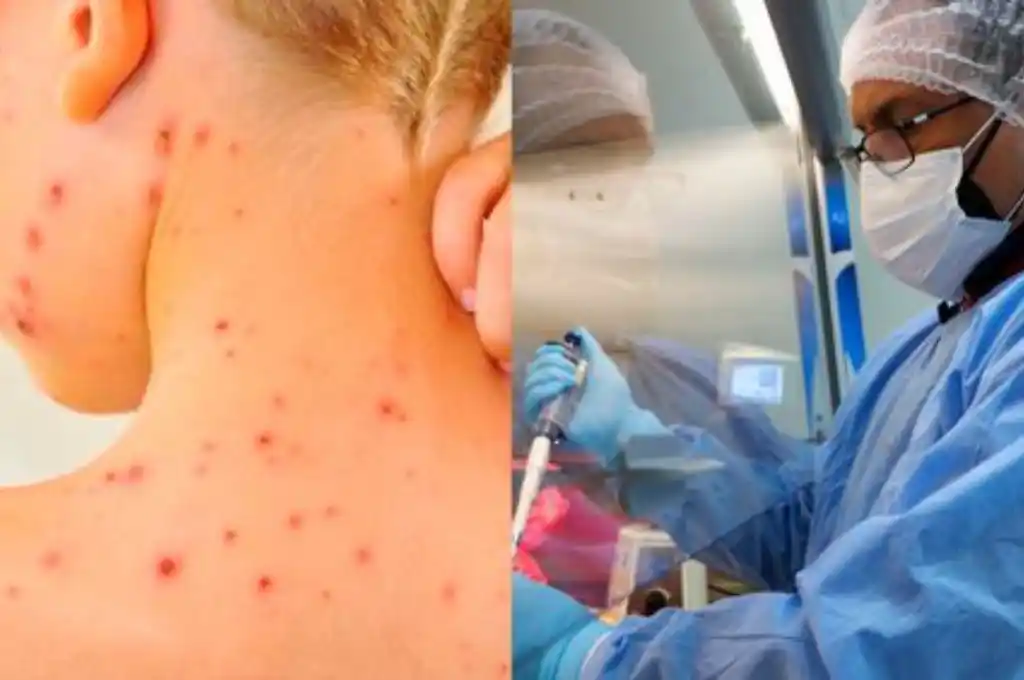 Evalúan un segundo caso sospechoso de viruela del mono en Argentina